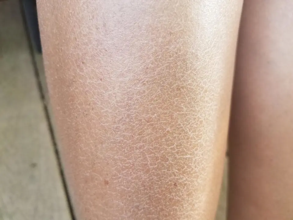 秋冬季节小腿瘙痒高发？了解乏脂性湿疹及其防治方法  第1张