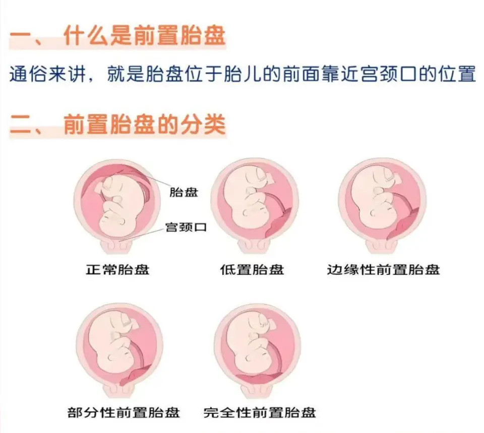 聊城市人民医院成功救治39岁高危产妇，生命保卫战温暖人心  第1张