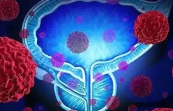 揭秘癌症真相：人人都有癌细胞，早期发现是关键  第4张