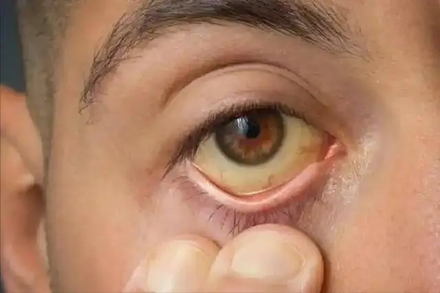 眼睛发黄与肝脏健康的关系：专家解析胆红素代谢异常  第1张
