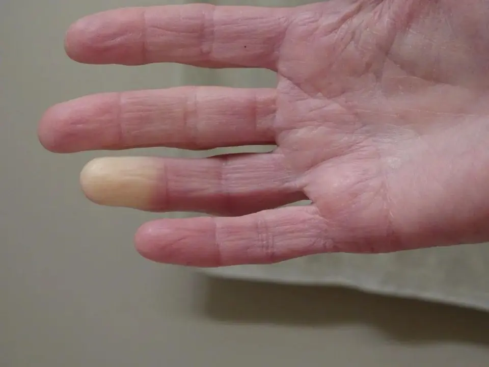 冬天手脚冰凉是身体保护机制？女生为何更易受影响？  第6张