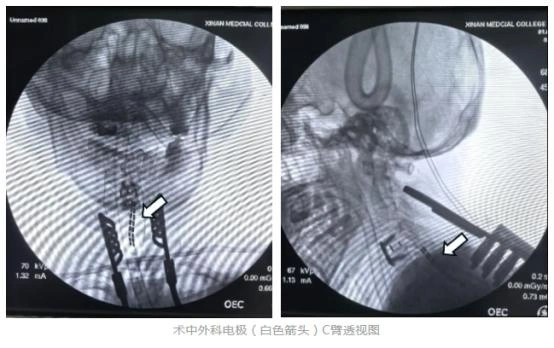 四川省首例脊髓电刺激治疗截瘫手术成功，患者术后康复显著  第1张
