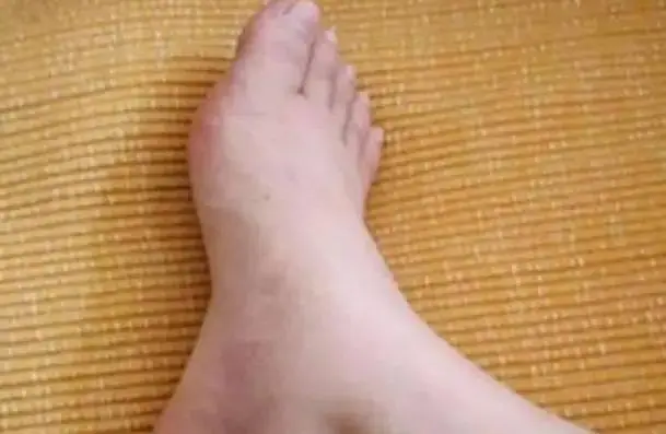 41岁男子尿酸过高并发尿毒症离世，长期摄入痛风帮凶食物是主因  第5张