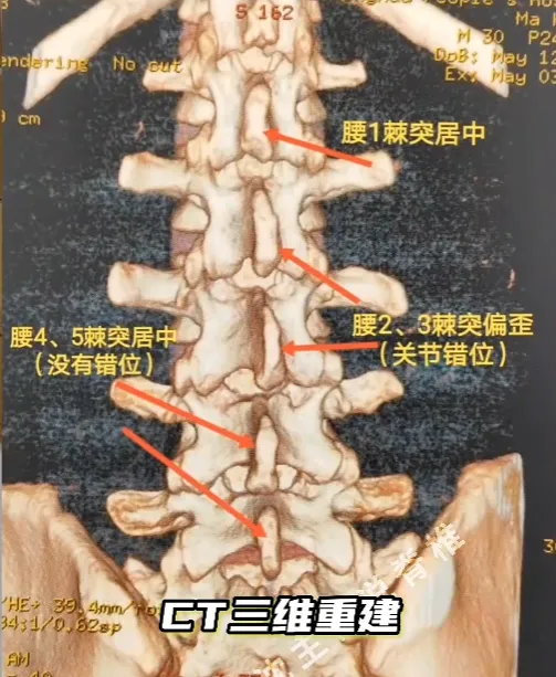 27岁钟先生腰痛困扰两年，龙脊康治疗后症状明显缓解  第6张